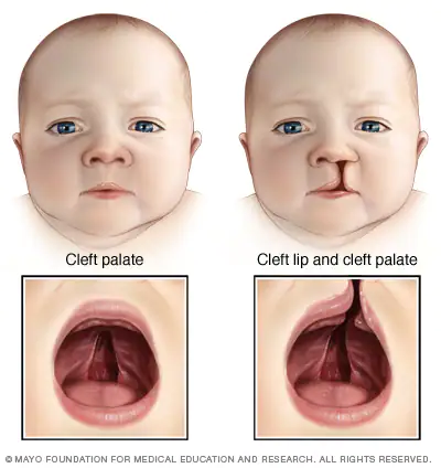 DiGeorge Syndrome