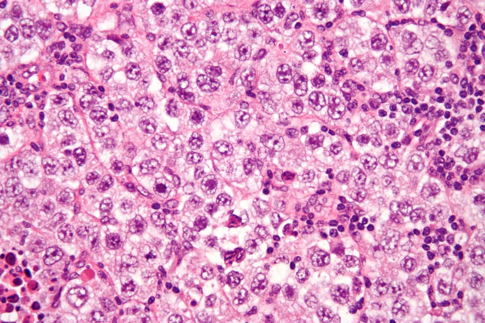 Germ cell tumor