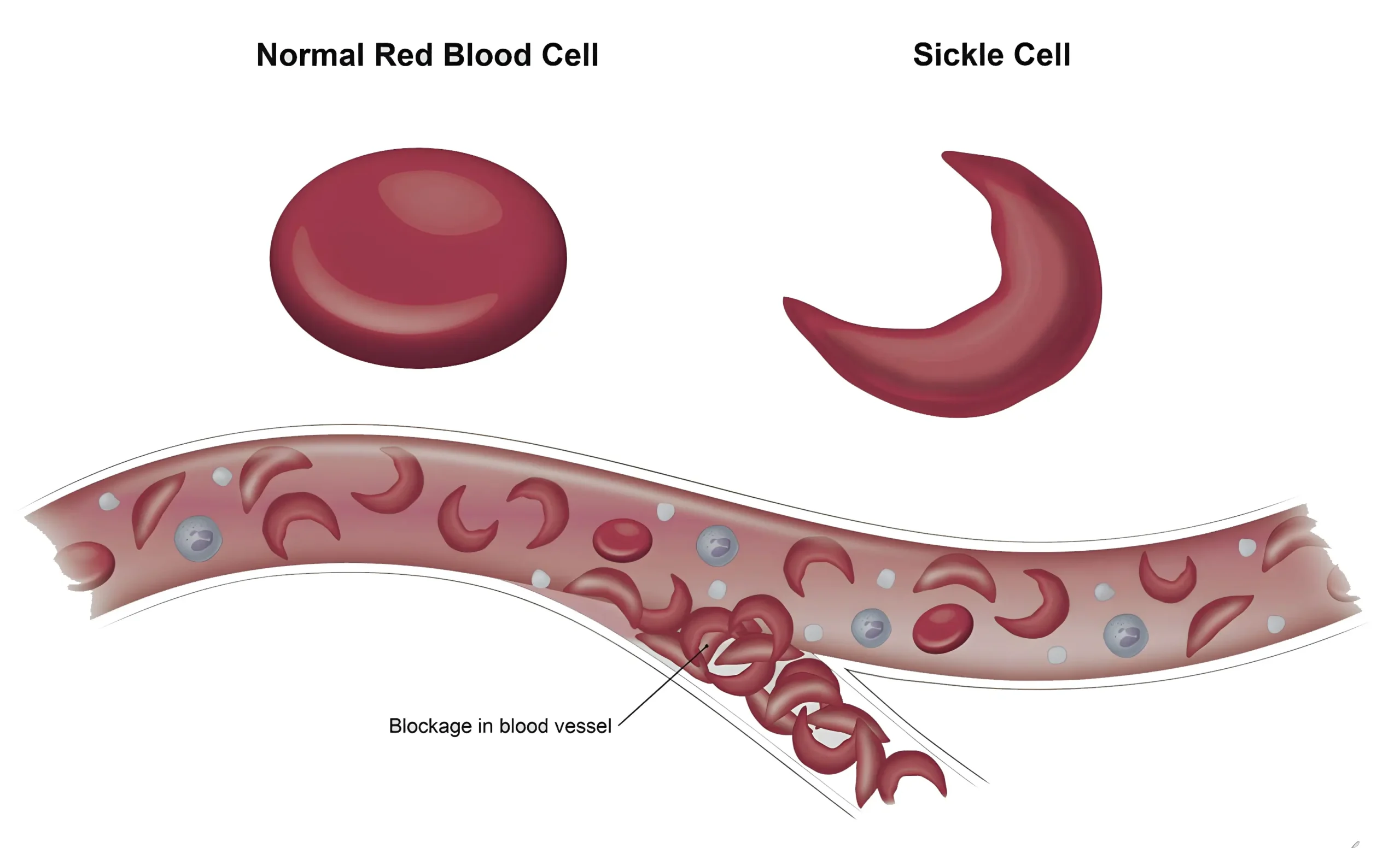 Sickle cell